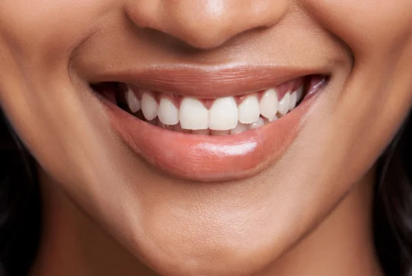 Trattamento Gummy Smile